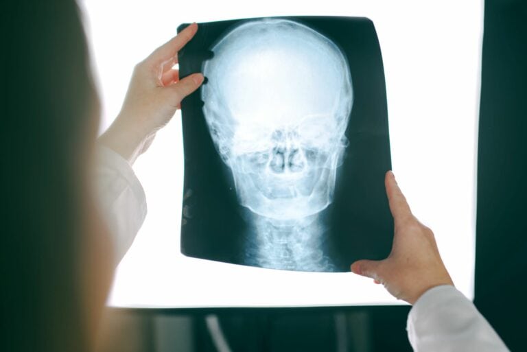 What is the Average Settlement for a Traumatic Brain Injury in California?
